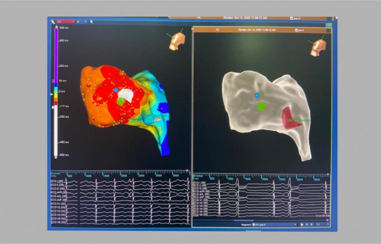 Hospital Dom Orione usa tecnologia desenvolvida na NASA para tratamento das arritmias cardíacas  - HDO - Reprodução // Efeito: Cícera Maria