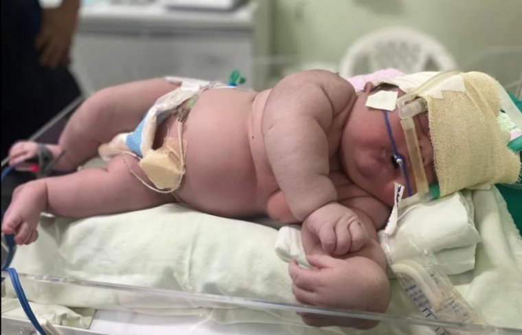 'Bebê gigante,' Angerson Santos, nasceu com mais de 7kg, em Parintins, no interior do AM.  Foto: Divulgação/Hospital Padre Colombo
